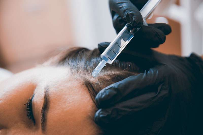 mésothérapie pour la perte de cheveux en Turquie
