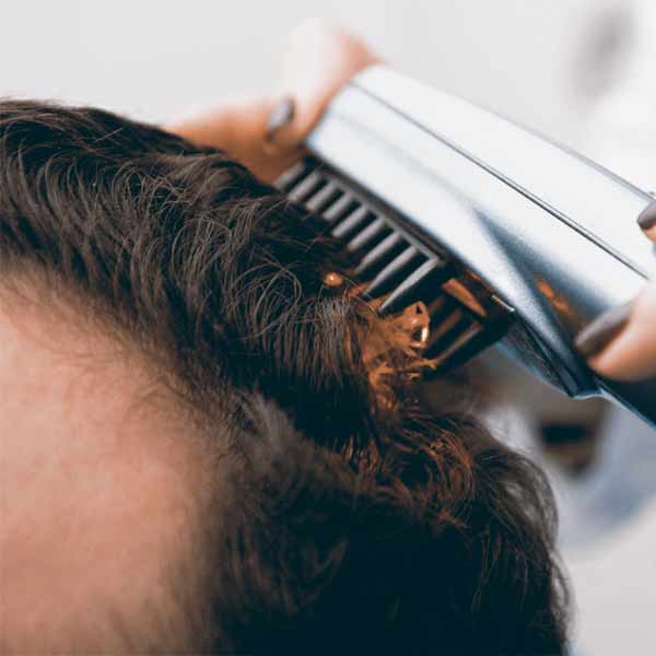Thérapie Laser Cheveux alopécie