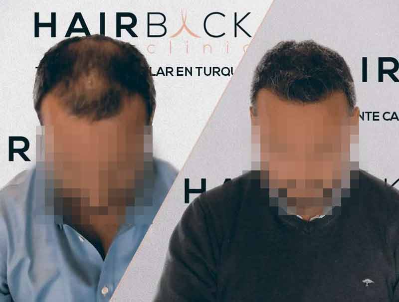 Greffe de cheveux en Turquie