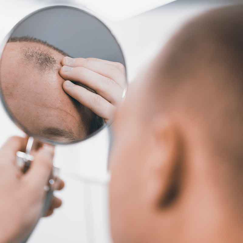 Comment poussent cheveux après greffe capillaire