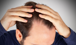Le Baricitinib - Traitement de la perte de cheveux - Greffe de cheveux en Turquie