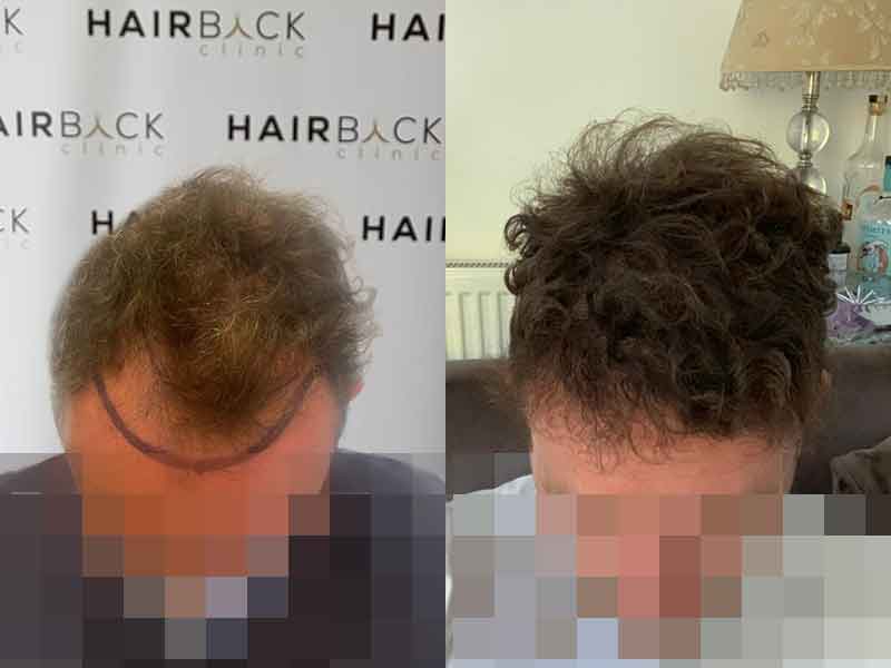 Resultat Turquie greffe de cheveux 12 mois après