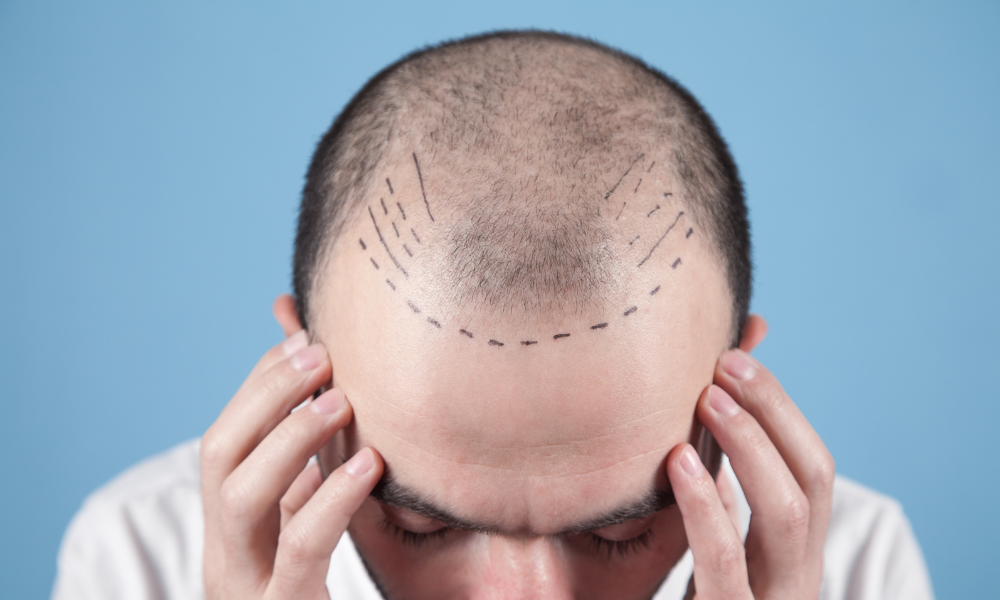 Types de lignes frontales - Greffe De Cheveux En Turquie