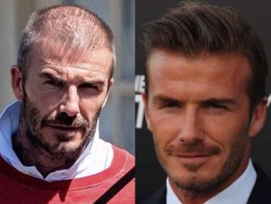 Athlètes célèbres avec greffe de cheveux - David Beckham