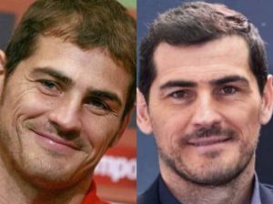Athlètes célèbres avec greffe de cheveux - Iker Casillas