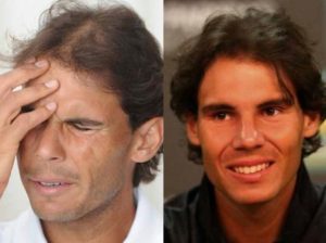 Athlètes célèbres avec greffe de cheveux - Rafael Nadal