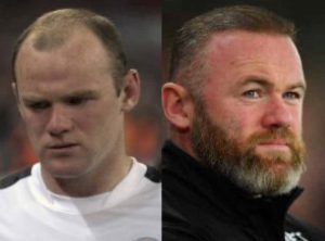 Athlètes célèbres avec greffe de cheveux - Wayne Rooney