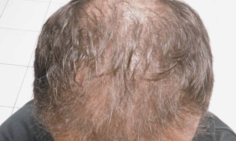 DHI FUE Résultats – 3 mois après la greffe de cheveux