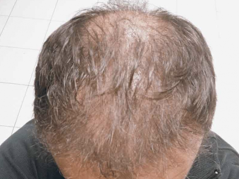 DHI FUE Résultats – 3 mois après la greffe de cheveux
