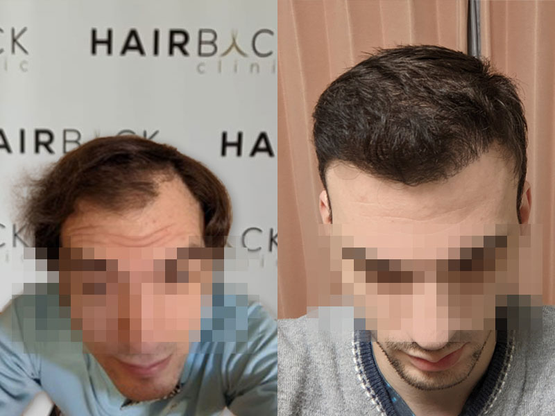 Resultat avant et après la greffe de cheveux