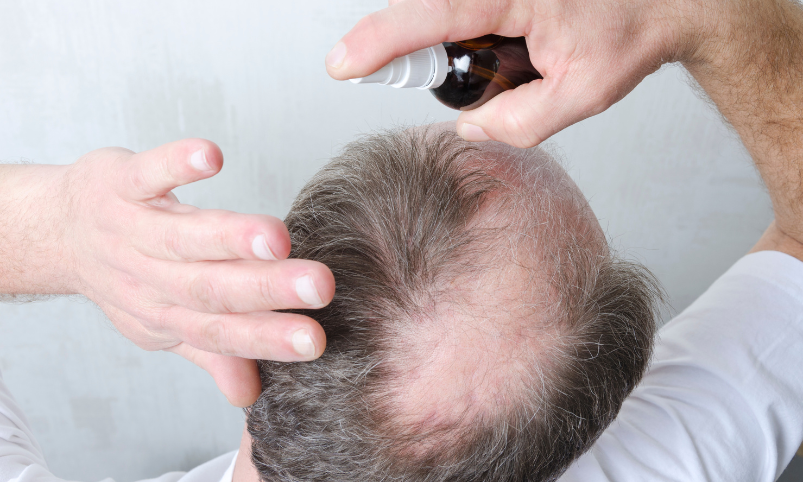 Greffe de cheveux entre 50 et 60 ans, ça fonctionne (1)