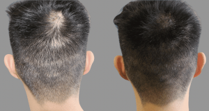 micropigmentation cheveux