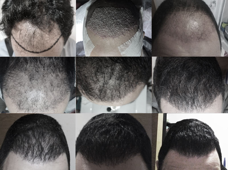 Resultat avant et après la greffe de cheveux