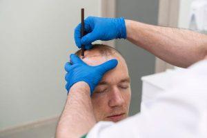 long term results of a hair transplant