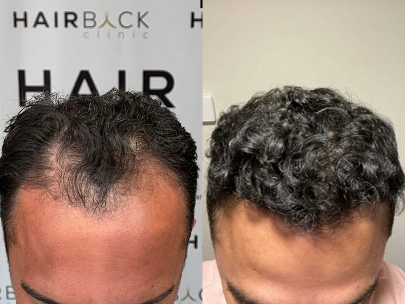 Resultat-greffe-cheveux-Turquie-HairBack Clinic
