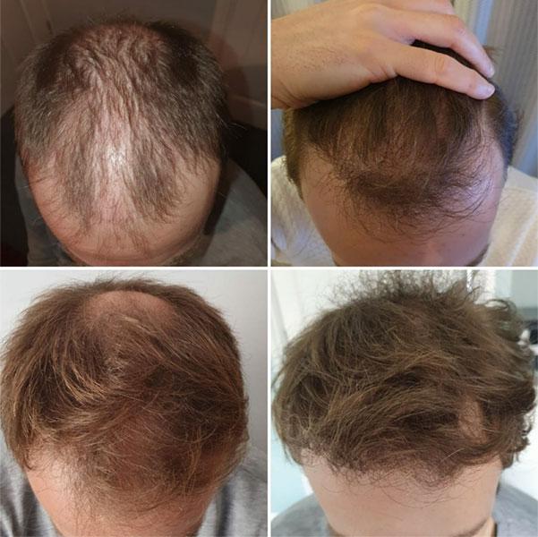 Resultat-greffe-cheveux-Turquie-HairBack Clinic