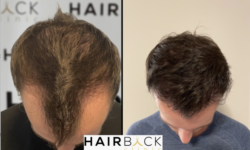 Résultat HairBack Clinic Turquie