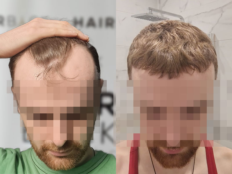 résultat greffe de cheveux Turquie