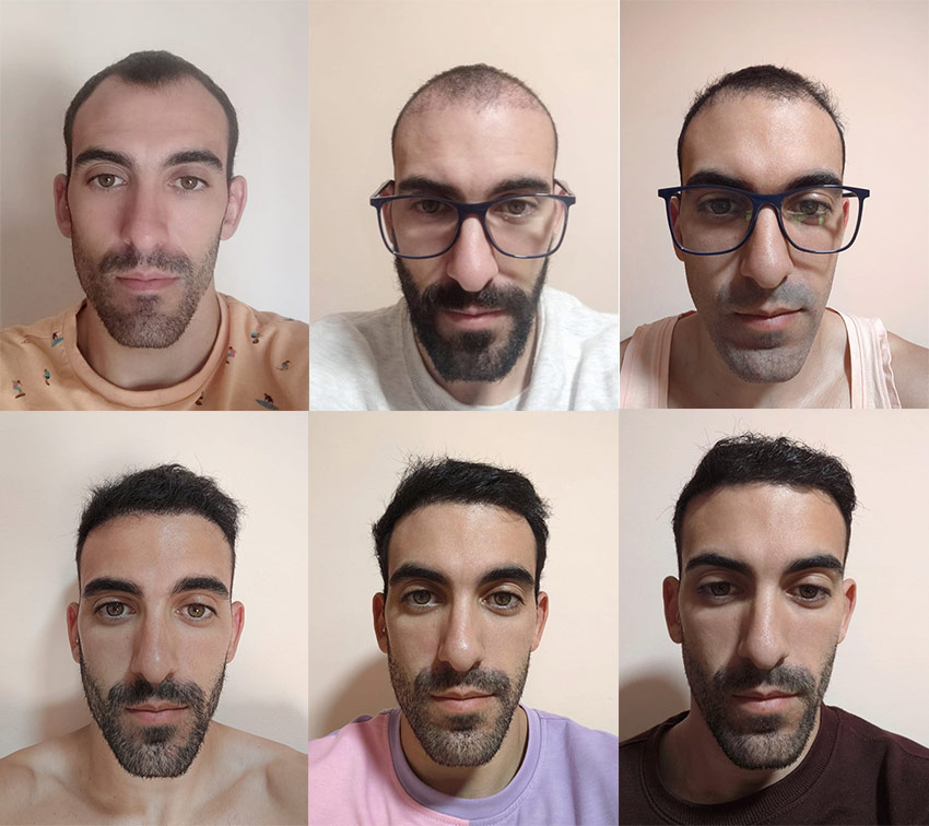 résultat greffe de cheveux Turquie Avant après HairBack Clinic