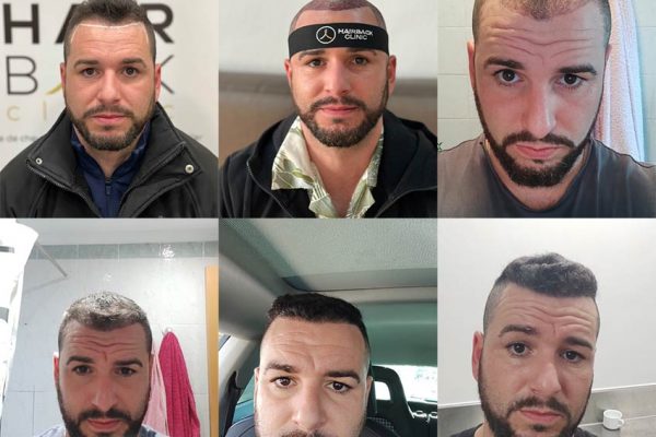 résultat greffe de cheveux Turquie Avant après HairBack Clinic