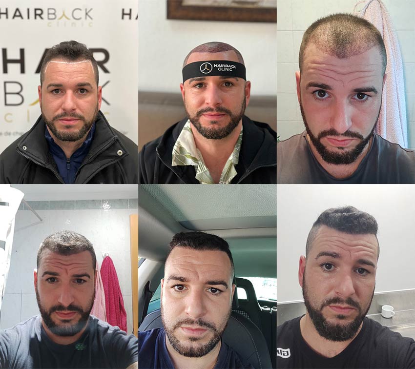 résultat greffe de cheveux Turquie Avant après HairBack Clinic