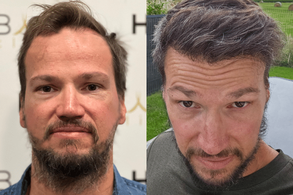 résultat greffe de cheveux Turquie Avant après HairBack Clinic