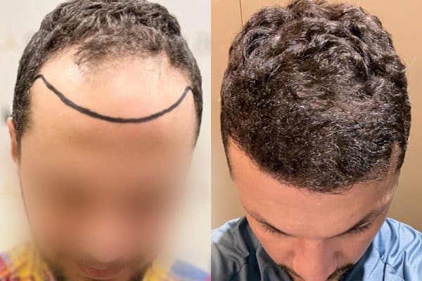 résultat greffe de cheveux Turquie Avant après HairBack Clinic