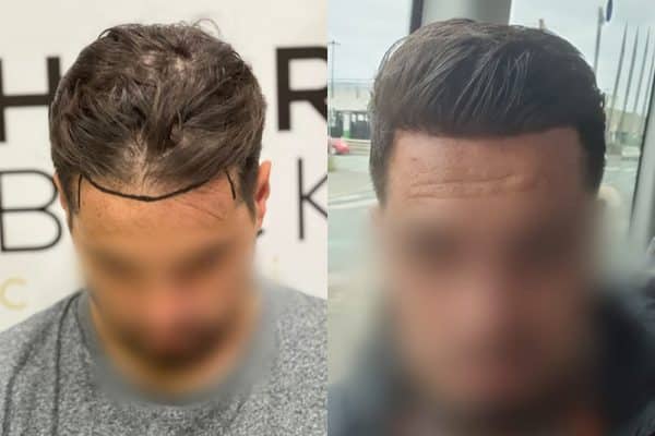 résultat greffe de cheveux Turquie Avant après HairBack Clinic