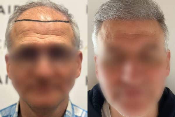 résultat de greffe de cheveux en Turquie 12 mois après