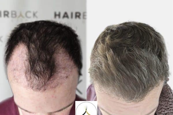 Greffe de cheveux résultat 2