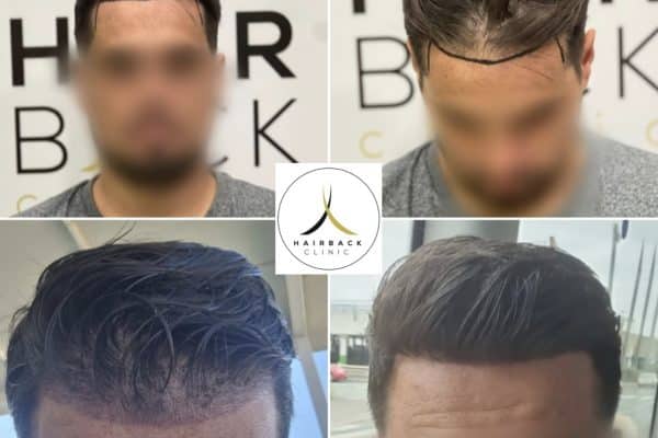 Greffe de cheveux en turquie contour