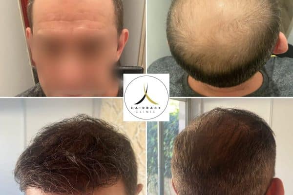 Greffe de cheveux en turquie après Calvitie