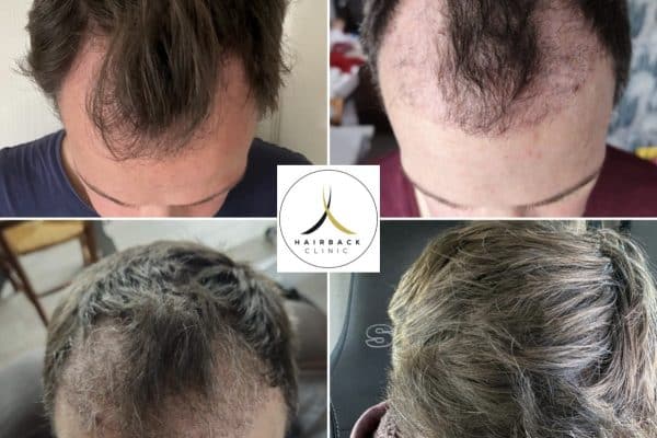 Greffe de cheveux en turquie Golfes dégarnis