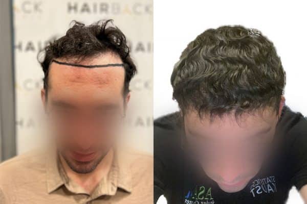 résultat de greffe de cheveux en Turquie 12 mois après