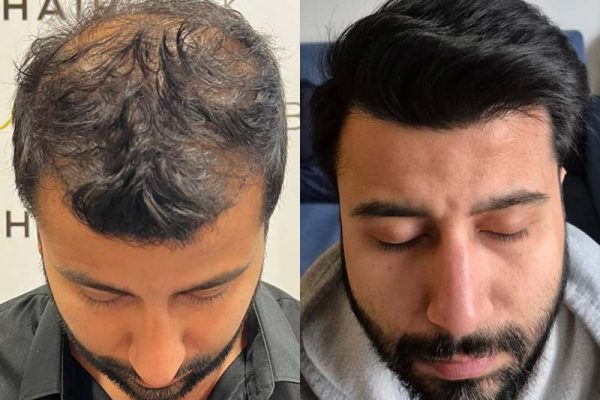 résultat de greffe de cheveux en Turquie 9 mois après
