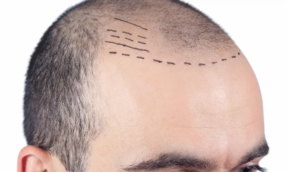 Combien coûte une greffe de cheveux en France en 2025 ? 23 greffe de cheveux pour planter des greffons sur les golfes