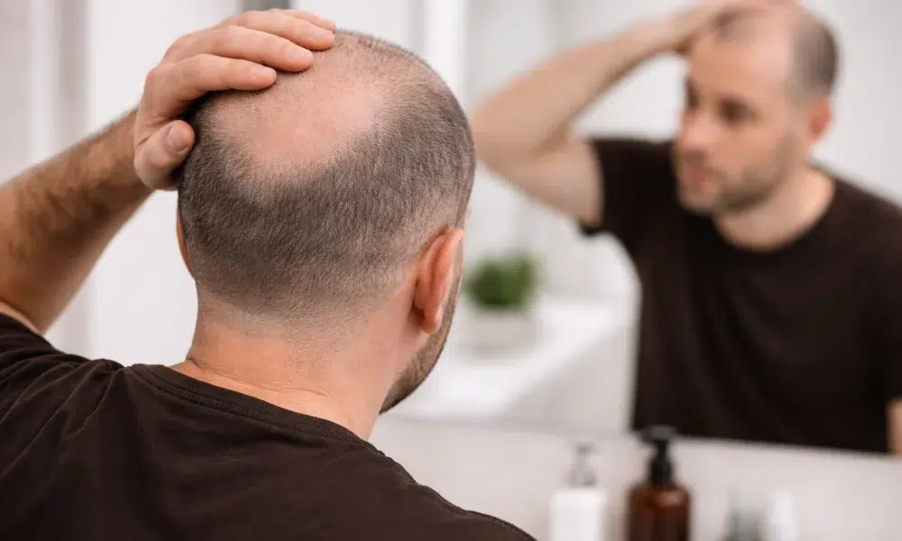 Image - Calvitie Masculine