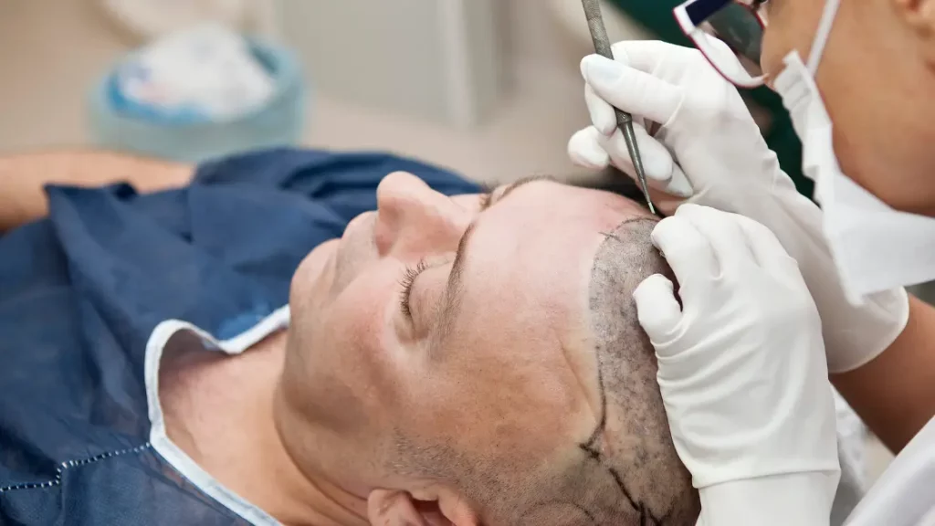 microgreffe de cheveux sur un homme