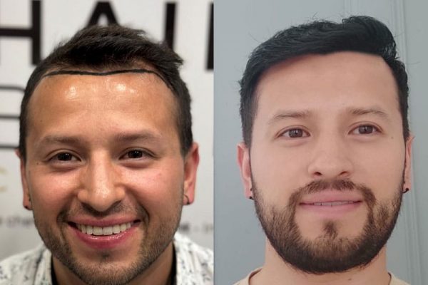 résultat de greffe cheveux Turquie 12 mois après