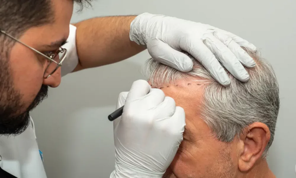 Greffe de cheveux ratée : que faire ? 2 image montrant un chirurgien qui souhaite corriger une greffe de cheveux ratée