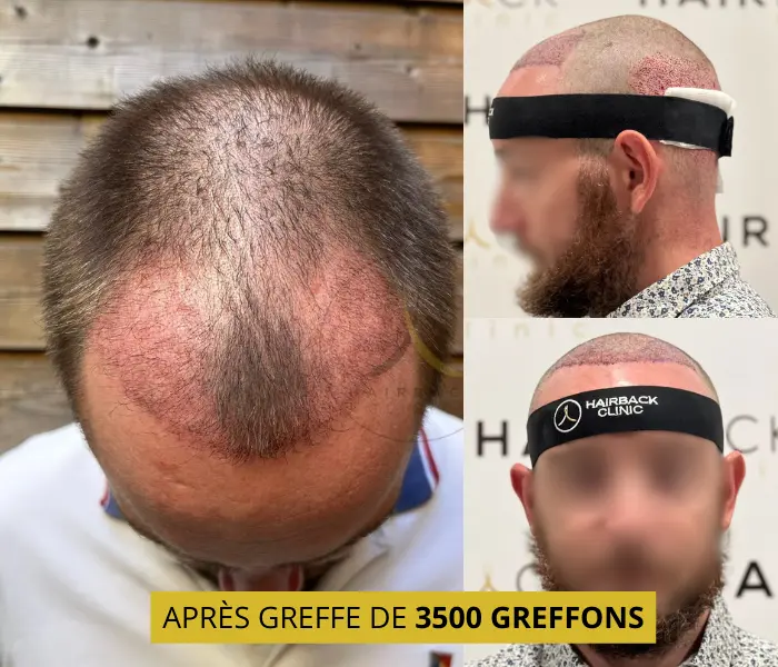 Après la greffe de 3500 greffons