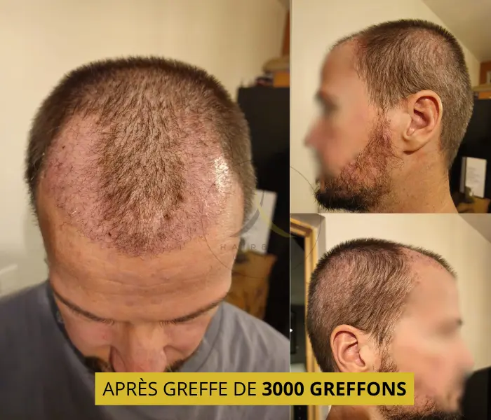 Après greffe de 3000 greffons