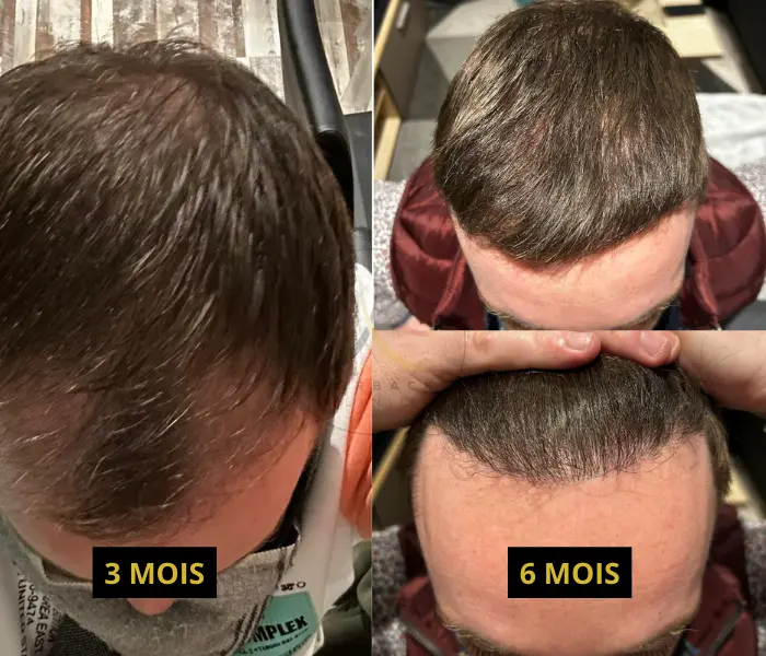 3 et 6 mois après la greffe de 3500 greffons