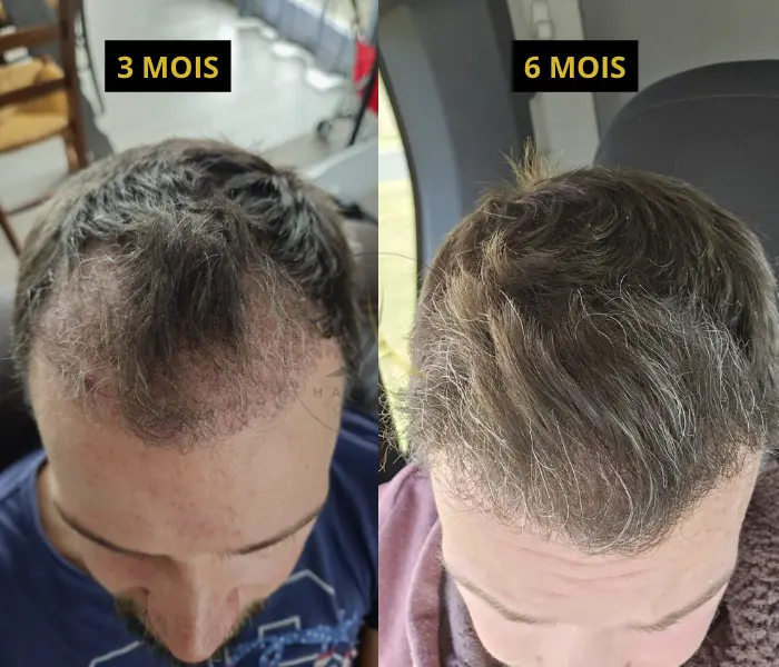 3 et 6 mois Avant après 3000 greffons