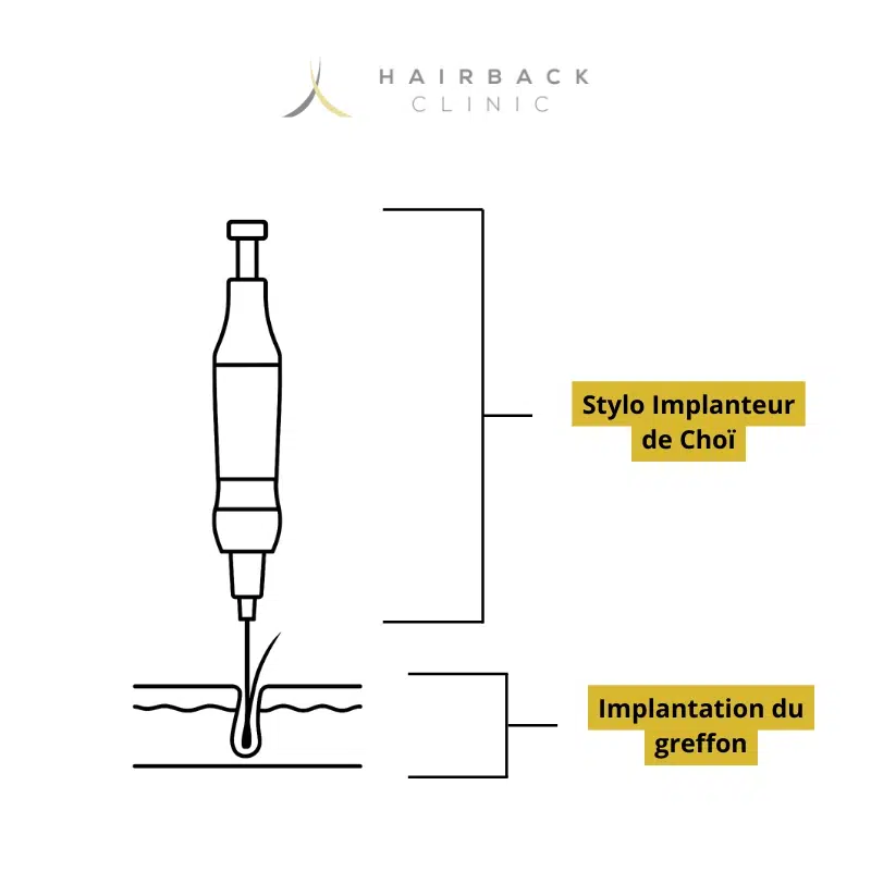 Implanteur de Choi : guide de la technique de greffe ! 1 Schema explicatif du stylo implanteur de Choï