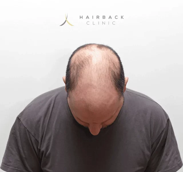 Effluvium Cheveux : effets, conseils et solutions ? 19 un homme victime de l'effluvium cheveux