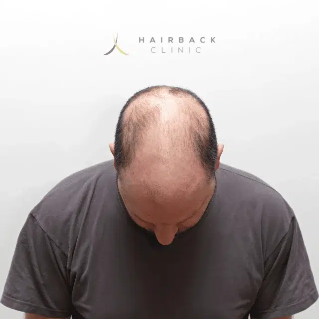 un homme victime de l'effluvium cheveux