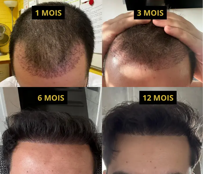 2000 à 2500 greffons avant/après 2 Post-opératoire greffe de 2000 greffons