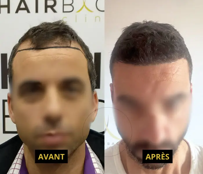 2000 à 2500 greffons avant/après 5 2000