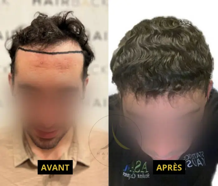 2000 à 2500 greffons avant/après 4 2500